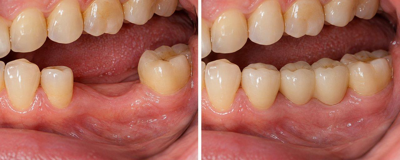 Planowanie mostu na implantach
