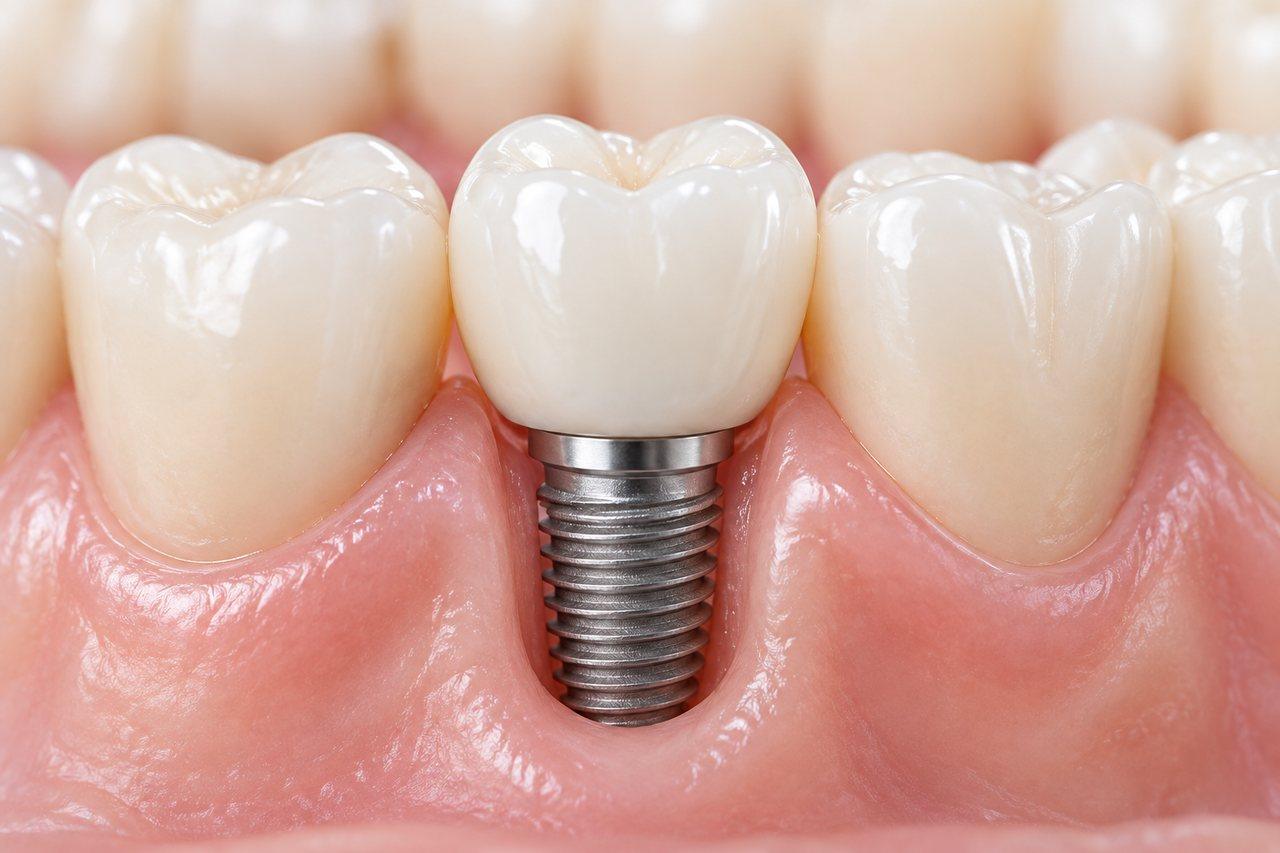 Pojedynczy implant z koroną